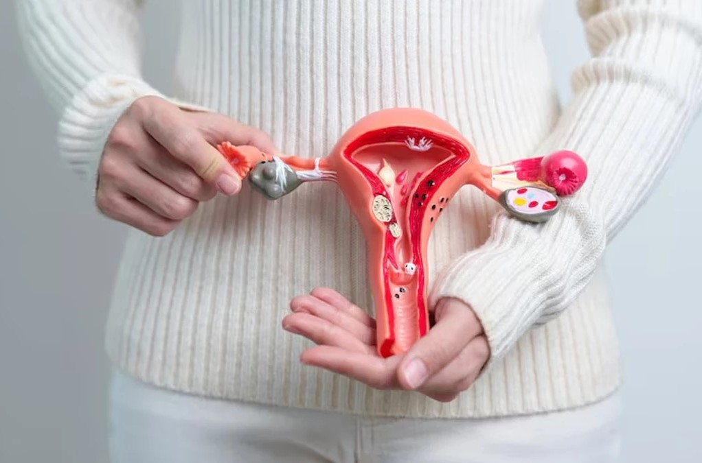 PCOS यानी पॉलिसिस्टिक ओवरी सिंड्रोम महिलाओं में तेजी से बढ़ रही एक हार्मोनल बीमारी है—समय पर जांच और जीवनशैली में बदलाव से इसका निदान संभव है