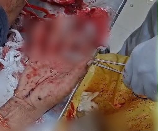 दमोह में जमीन विवाद ने लिया हिंसक रूप, कुल्हाड़ी के वार से किसान की चार उंगलियां कटीं