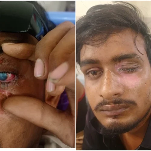 कार्बाइड गन से आंखों में गंभीर चोट, डॉक्टरों ने रोशनी बचाने के लिए लगाई गर्भनाल की झिल्ली